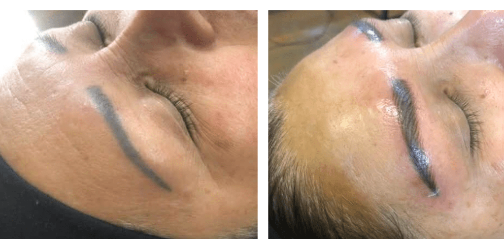 re working an old tattoo to improve shape and overall appearance
